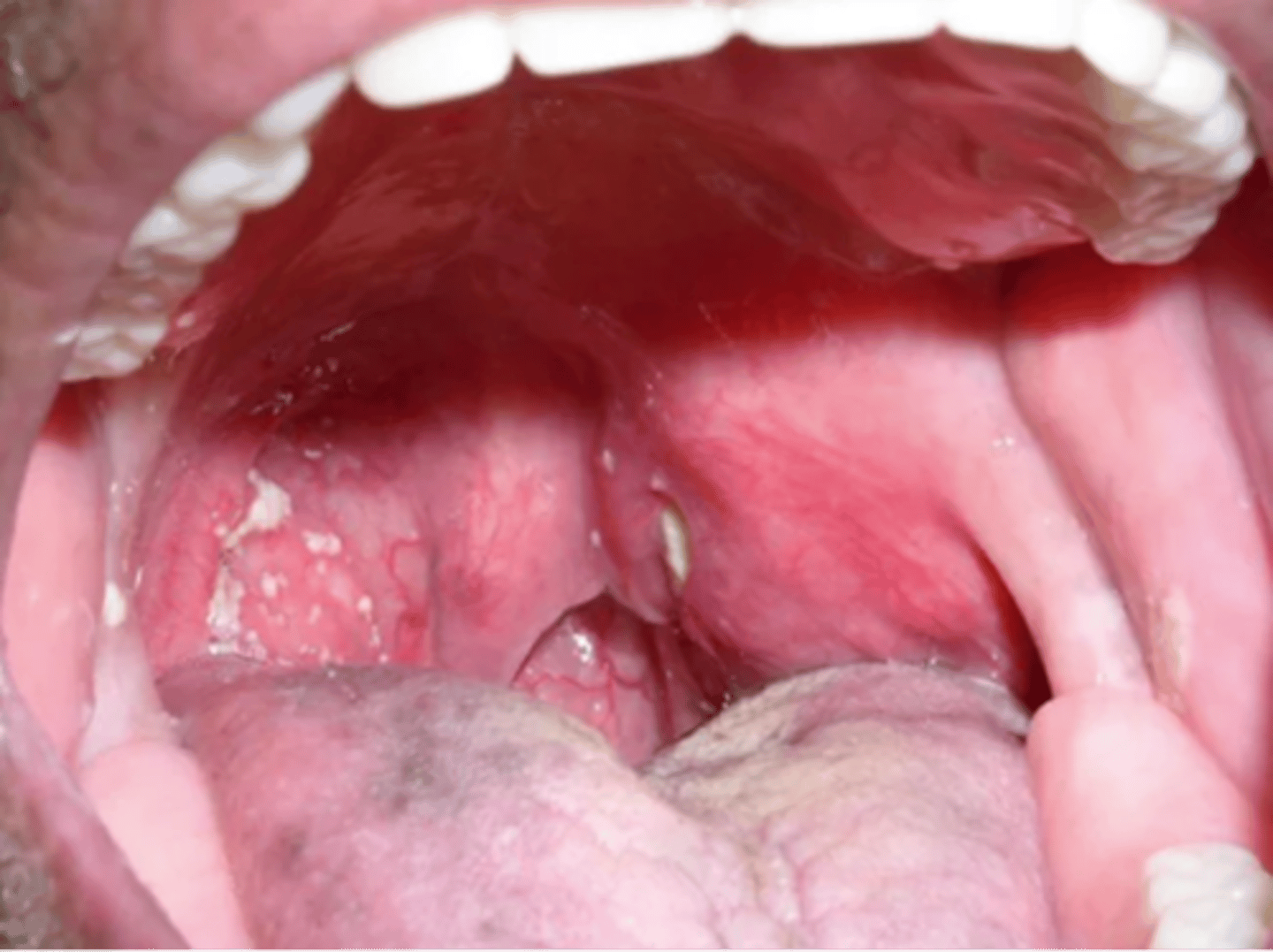 <p>Peritonsillar abscess treatment</p>
