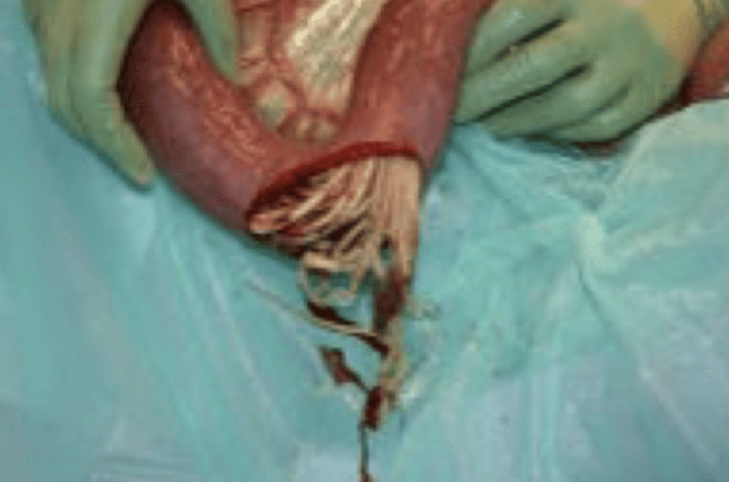 <p>En plag på 6 måneder har udviklet akut kolik 2 dage efter ormebehandling. Plagen opereres pga svære koliksmerter og vedvarende positiv ventrikelskylning. Ved operationen foretages enterotomi, hvor dette indhold udtømmes af tyndtarmen. Hvordan behandles ungheste med stor mængde af netop denne parasit bedst for at undgå dette problem?</p><p>- Fenbendazol</p><p>- Pantoprazol</p><p>- Ivermectin</p><p>- Moxidectin</p>