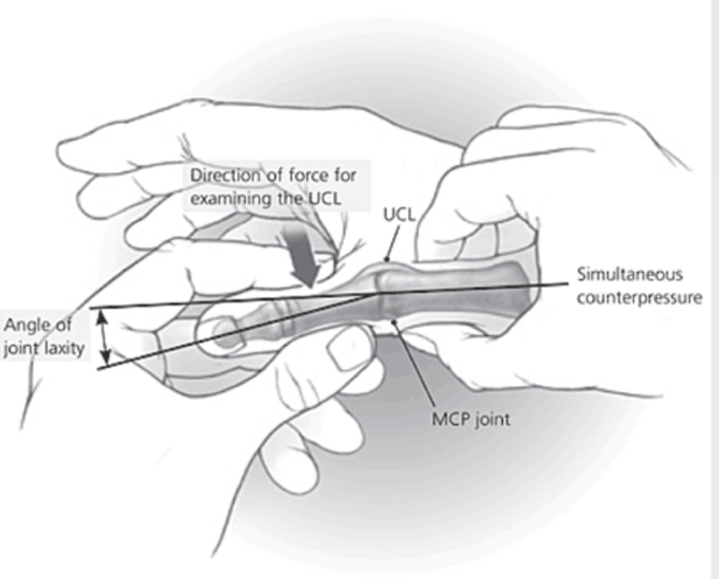 <p>Valgus stress test in MP extension</p>