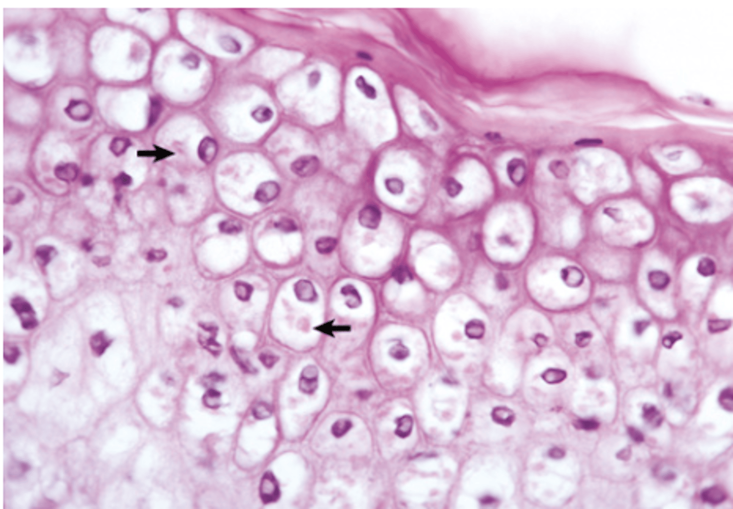 <p>This type of acute cell swelling is reserved for talking about what type of infection?</p>