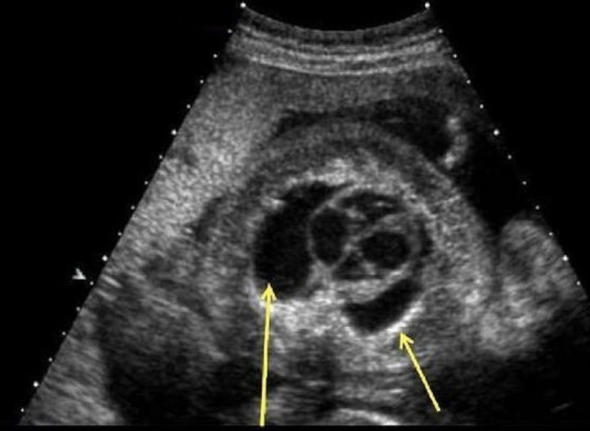 <p>a) pericardiac effusion</p><p>b) pleural effusion</p><p>c) hydronephrosis</p><p>d) ascites </p>