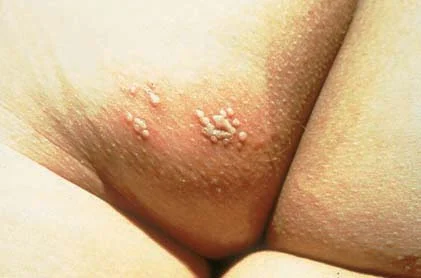 <p>cold sores</p><p>group vesicles on erythematous base</p><p>mouth, genital, and skin</p>