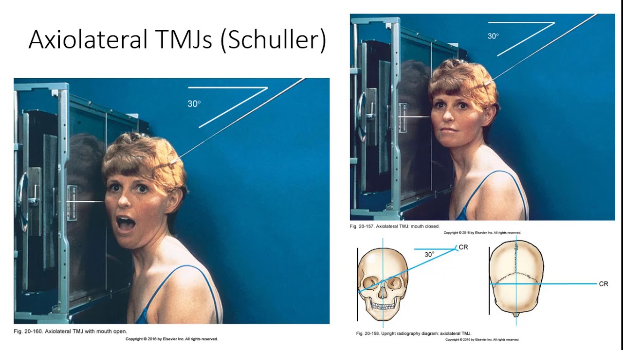 <p>25-30° caudal thru 2” above and ‘5” anterior to EAM</p><p></p>
