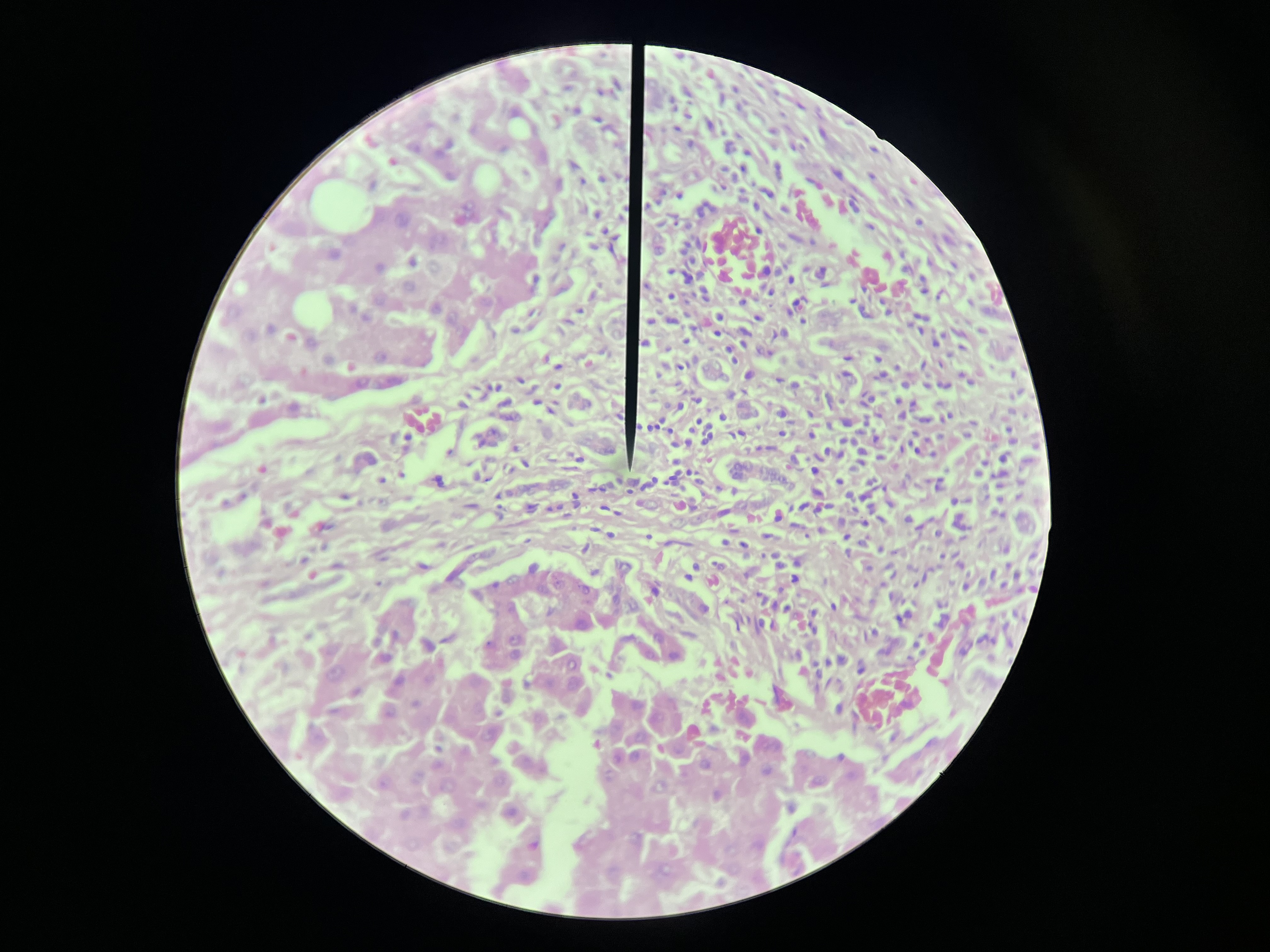 <p>A chronic liver disease marked by scarring, liver cell degeneration, and impaired liver function. </p>