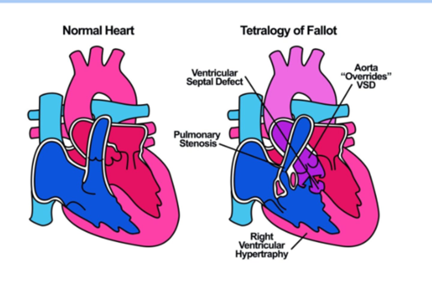 <p>-most common cyanotic CHD </p><p>-ventricular septal defect</p><p>-right ventricle hypertrophy</p><p>-right ventricular outflow tract obstruction</p><p>-overriding aorta </p>