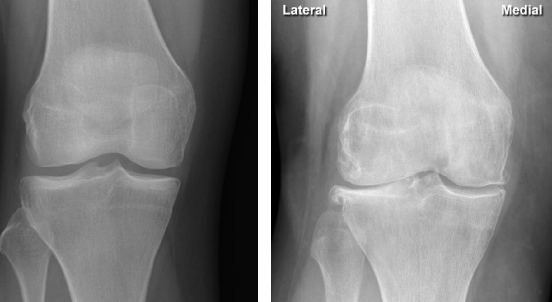<p>Loss of joint space (fusion of bones) indicating cartilage loss at the lip of the femur with osteophytes </p><p>(indicating OA, sometimes also formation of cysts - erosions are <u>not</u> a feature)</p>