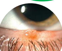 <p><u>Elevated </u>and lightly colored or <u>depigmented</u></p><p><u>Located in dermis</u></p><p>Found in older adults</p>