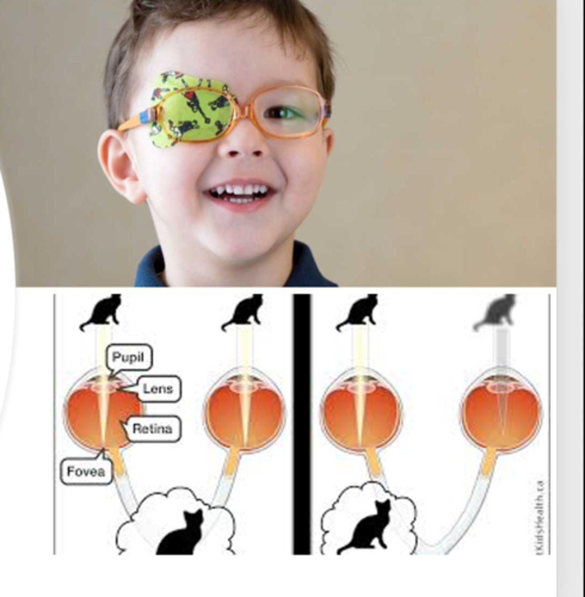 <p><u>Etio</u>: <strong><mark data-color="#fdff00" style="background-color: #fdff00; color: inherit">most common cause of pediatric visual impairment,</mark></strong> strabismic (misalignment) and refractive (&gt;2 line difference)</p><p><u>Risk Factors</u>: <strong><mark data-color="#f7ff00" style="background-color: #f7ff00; color: inherit">premature, small size for gestational age</mark></strong>, 1st degree relative with amblyopia, neurodevelopmental delay</p><p><u>S&amp;S</u>: <strong>reduction in visual acuity, &gt;2-line differences between eyes, usually unilaterally</strong></p><p><u>Tx</u>: pediatric ophtho, tx cause</p>