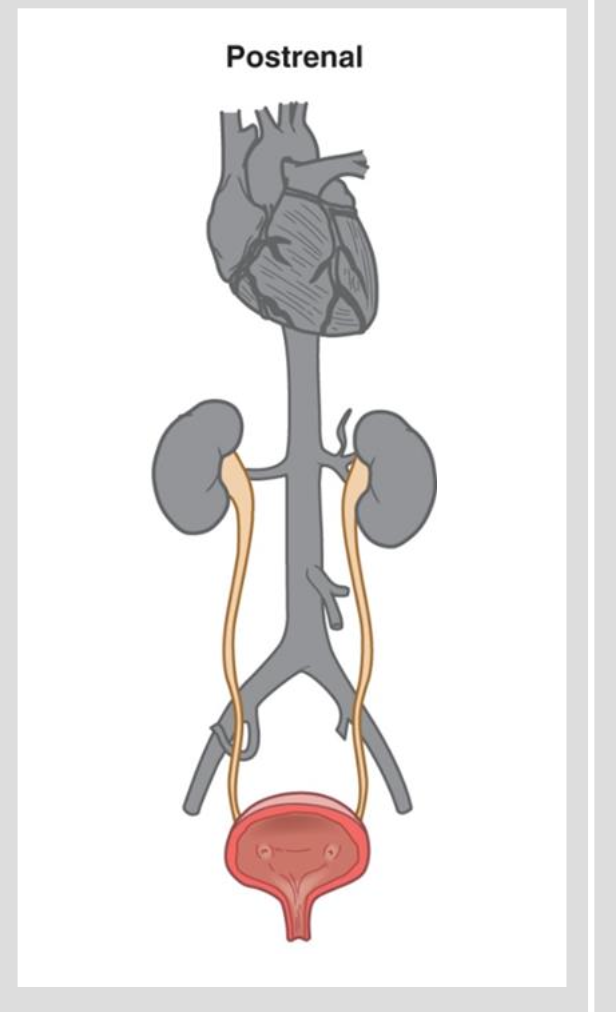 <p>Postrenal</p><ul><li><p>causes include mechanical obstruction of outflow</p><ul><li><p>lacerations</p></li><li><p>benign prostatic hyperplasia</p></li><li><p>prostate cancer</p></li><li><p>calculi</p></li><li><p>trauma!</p></li><li><p>extrarenal tumors</p></li><li><p>bilateral obstruction</p></li></ul></li></ul><p></p>