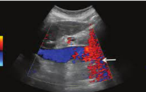 <p>sudden burst of Doppler signal caused by tissue motion, transducer motion, talking/coughing, bowel</p>