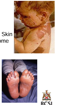 <p>food poisoning/gastroenteritis - short incubation period, self limiting</p><p>scaled skin syndrome - cleaves middles layers of skin. often occurs in outbreaks</p><p>toxic shock syndrome - multi system disease. high fever, hypotension, sunburn rash on soles and palms. vomiting diarrhea, confusion/headache. IV vancomycin plus gentamicin</p>