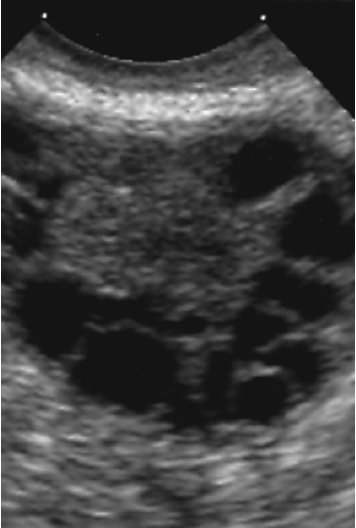 <p>PCOS</p>