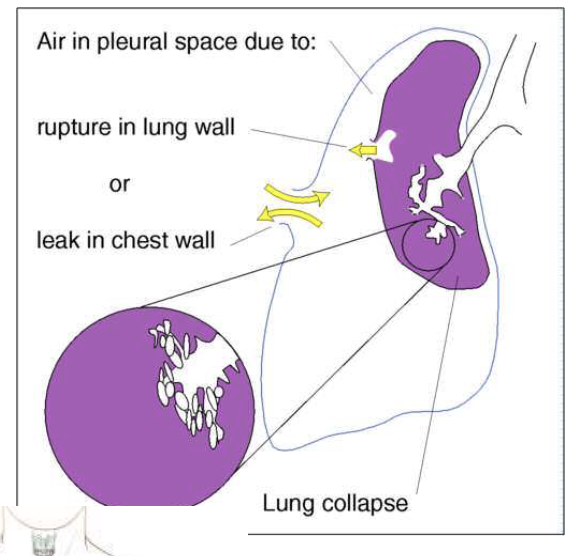 <p>air leak into the pleural space, usually unilaterally, causing the lung to recoil from the chest wall. Pocket of air in the pleural space blocks the transmission of sound via stethoscope </p><ul><li><p>trachea = shifted away from the involved side if excessive (tension pneumothorax)</p></li><li><p>tactile fremitus = decreased to absent over affected area </p></li><li><p>percussion = hyper-resonant over affected area </p></li><li><p>breath sounds = decreased to absent over affected area </p></li><li><p>adventitious sounds = none </p></li><li><p>usually accompanied by SOB/DOE and low O2 saturation </p></li><li><p>air leak into that airspace </p></li></ul><p></p>