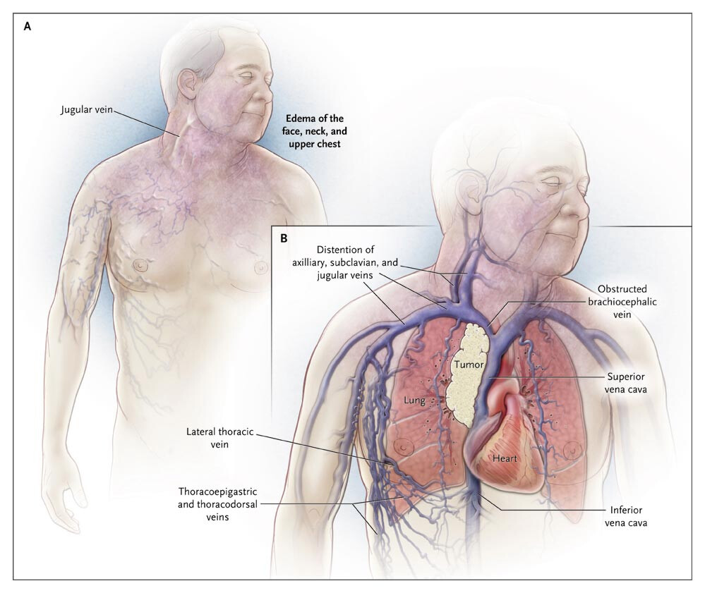 <ol><li><p>Upper thoracic &amp; facial edema</p></li><li><p>Cyanosis (specially on the lips)</p></li></ol><p></p>