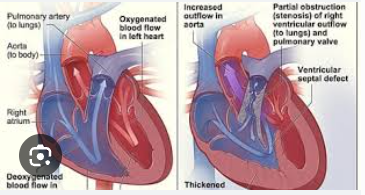 <ol><li><p>Ventrikelseptumdefect, de ernst bepaalt de mate van de cyanose. Het is altijd groot en ligt tegen de aortaklep.</p></li><li><p>Overrijdende aorta → aorta iets meer naar rechts en naar voren geplaatst, net boven het VSD. Hierdoor kan zowel zuurstofrijk als zuurstofarm bloed in de aorta stromen, dit laatste veroorzaakt cyanose.</p></li><li><p>Pulmonalisstenose, de ernst is bepalend voor de aandoening → obstructie van de rechterventrikel uitstroombaan, variërend van lichte stenose tot een atresie.</p></li><li><p>Rechterventrikelhypertrofie.</p></li></ol><p>=> Dit is één van de bekenste cyanotische aandoeningen met longvaatondervulling. In het begin is de pulmonalisstenose nog niet ernstig en staat cyanose niet op de voorgrond. Er is wel al een luid hartgeruis en op echo kan je de overrijdende aorta zien. Op een RX-thorax is een klomphart te zien.</p>