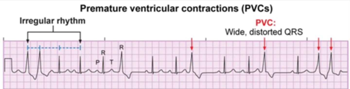 <p>- ectopic foci in the ventricles cause an early QRS complex, which appears as wide, distorted QRS</p><p>- 3+ PVCs = VTACH</p><p>- Caused by stimulants, electrolyte imbalances, hypoxia, heart disease</p><p>- Only harmful if the patient already has heart disease</p><p>- Note: monitor for pulse deficit</p><p>- Treatment: correct cause, antidysrhythmic</p>