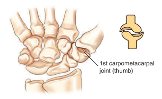 <ul><li><p>1st carpometacarpal joint</p></li><li><p>angkle joint</p></li><li><p>calcaneocuboid joints</p></li></ul><p></p>