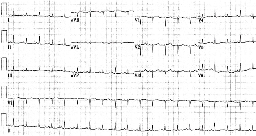 <p>What abnormality on an ECG would indicate the pt is suffering from pericardial tamponade?</p>