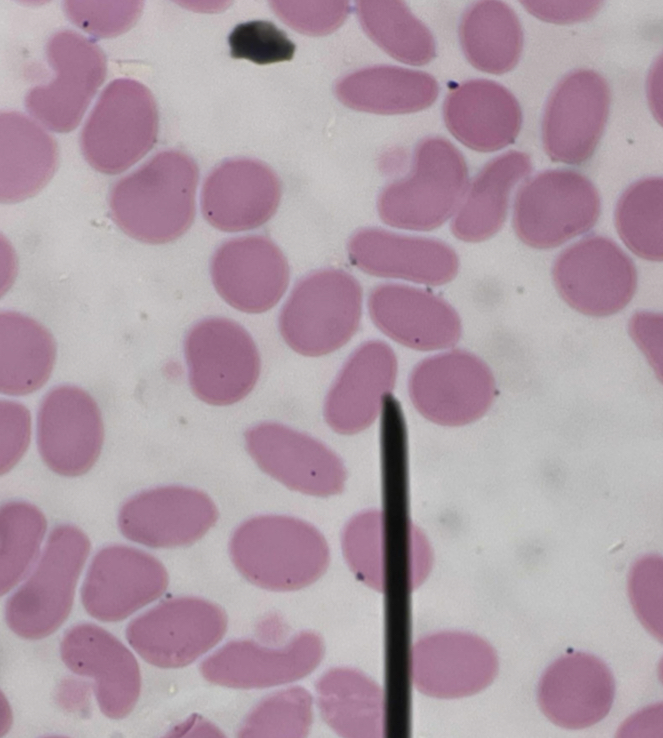 <p>A. Identify the pointed cell</p><p>B. Describe the striking feature</p><p>C. Associated with what condition ?</p><p>D. Main membrane defect?</p>