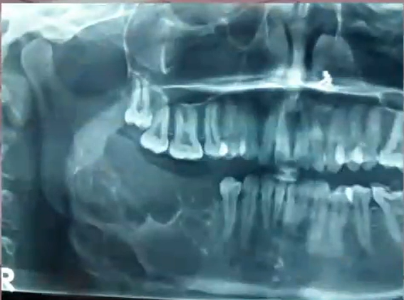<p>how would you describe this lesions: </p><p>ground glass </p><p>unilocular </p><p>cotton wool </p><p>multilocular </p>