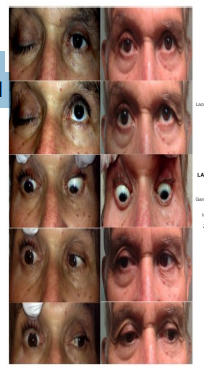 <ol><li><p>• Unilateral vision loss with ophthalmoplegia involving multiple cranial nerves </p><ol><li><p>• Vision loss is due to CN II being affected. Optic atrophy can occur weeks to months after initial presentation if no remedied • </p></li><li><p>Ophthalmoplegia due to involvement of • CN III, IV, VI • </p></li></ol></li><li><p>Periorbital facial pain and forehead hypoesthesia due to CNV1 involvement </p><ol><li><p>• Decreased corneal sensitivity </p></li></ol></li><li><p>• Mydriasis and ptosis •</p><ol><li><p> Due to CN III involvement</p></li></ol></li></ol><p> • Proptosis</p><p>• Injection/chemosis</p><p></p>