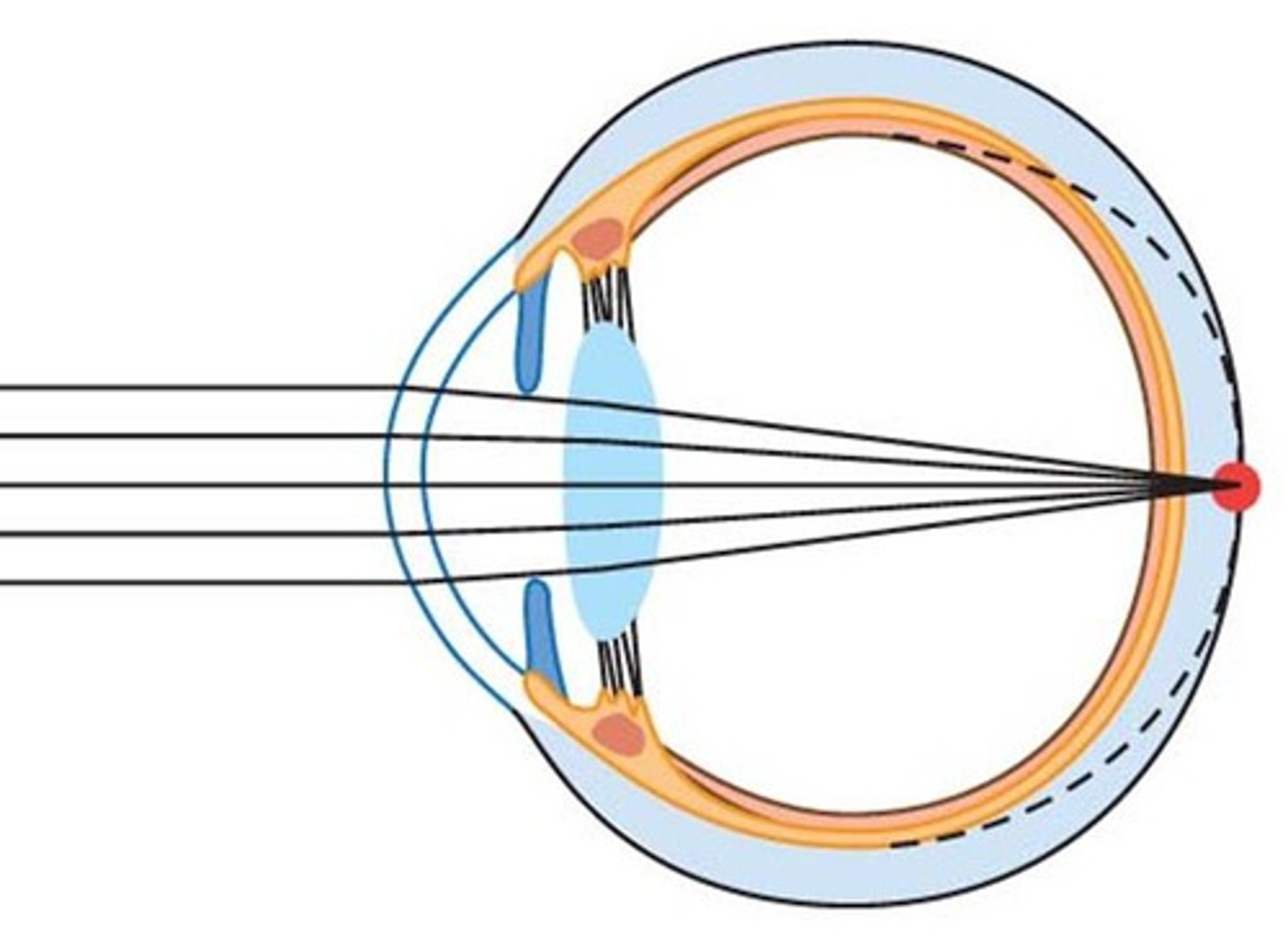 <p>-long sightedness due to light rays being focused in behind the retina</p><p>-issue is corrected with a convex lens</p>