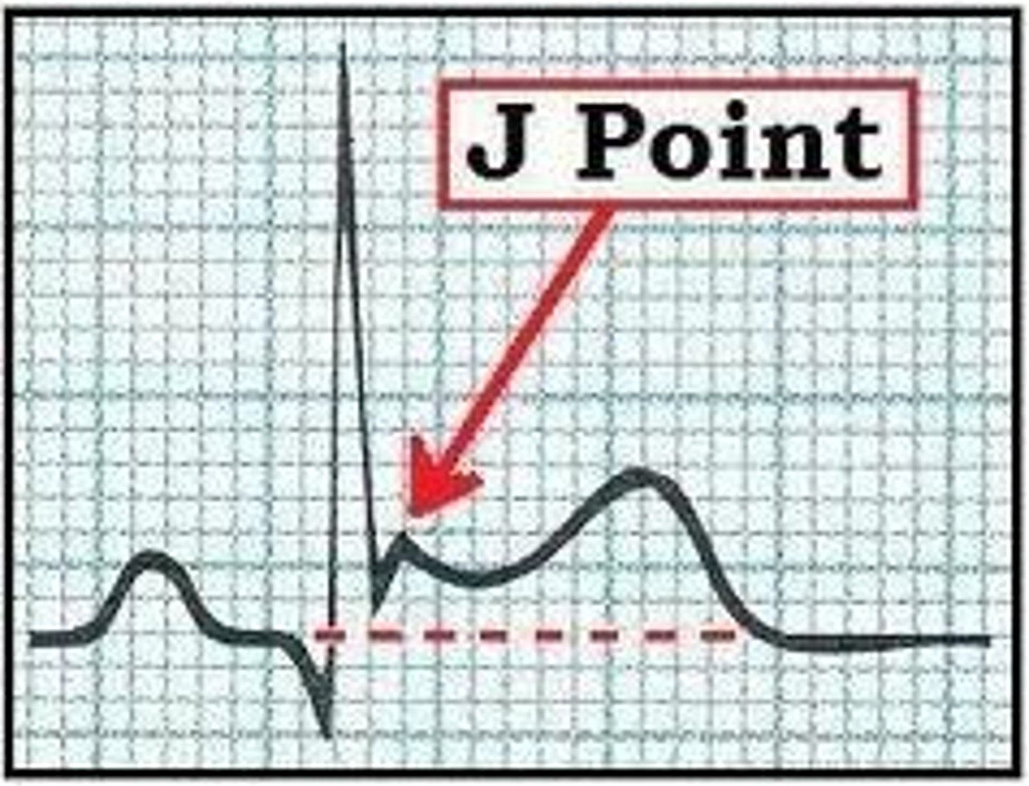 <p>end of the QRS which determines elevation or depression</p>