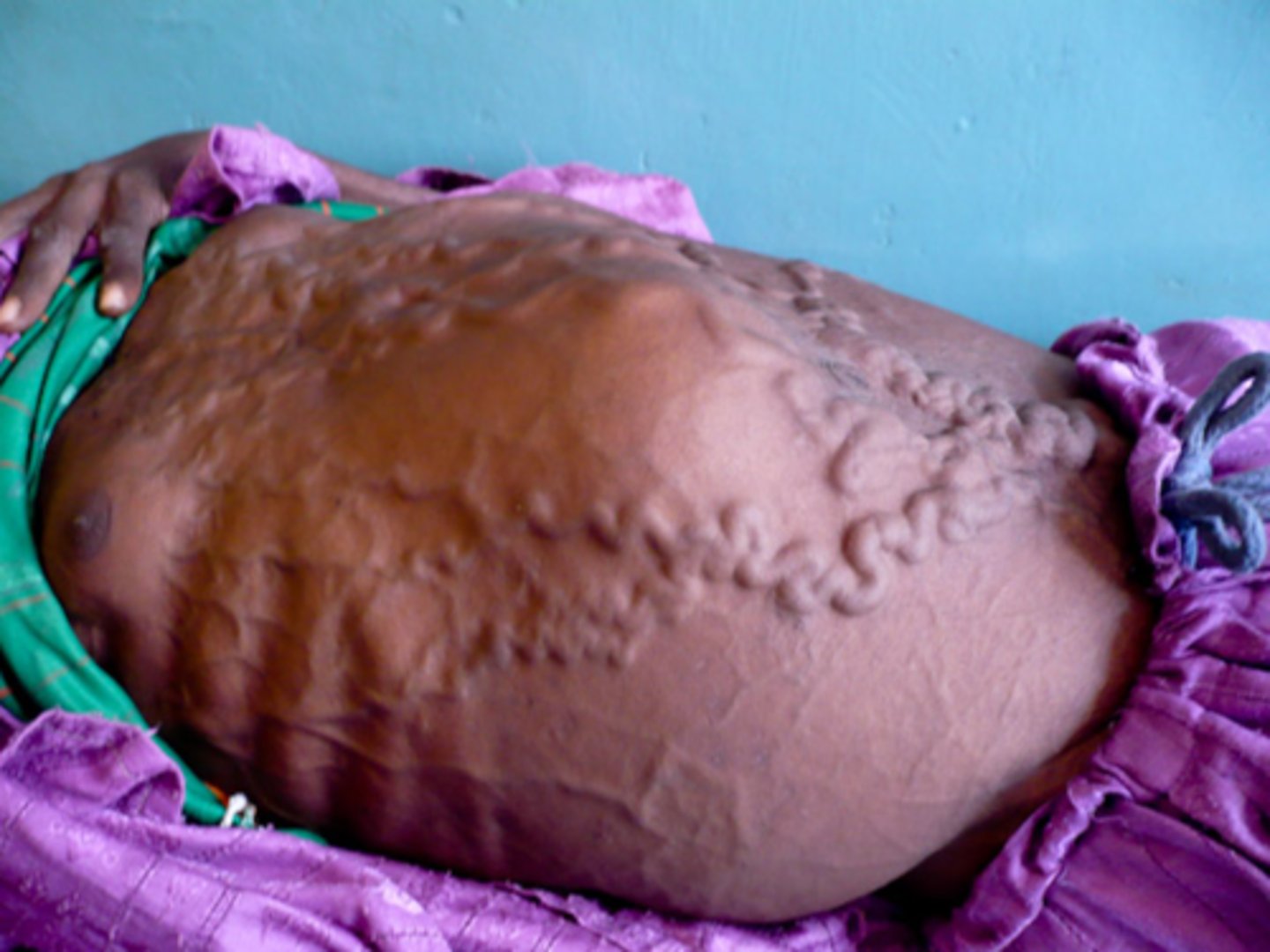 <p>Caput medusa</p><p>portal vein affected is paraumbilical vein: cannot drain into portal system, thus they drain into the superior, inferior, and thoracoepigastric veins</p>