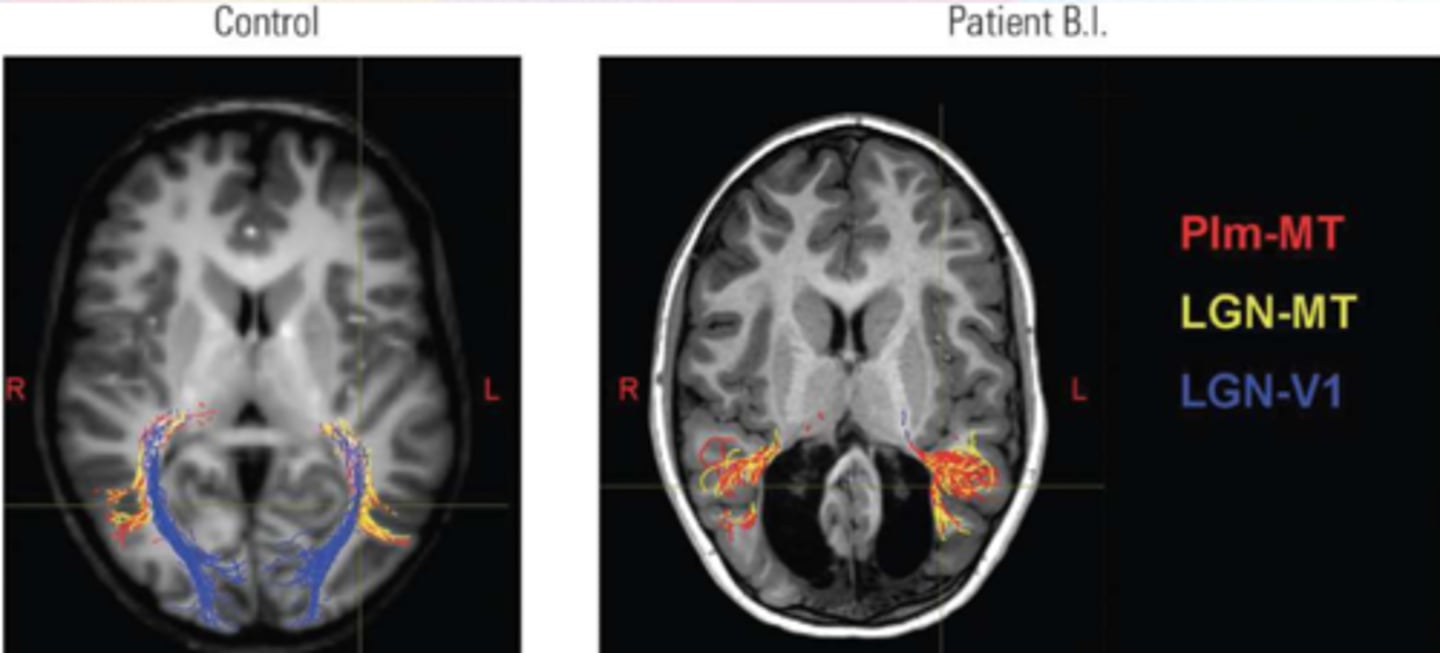 <p>Child sustained damage to the occipital lobe bilaterally in the first 2 weeks of life due to a genetic disorder<br>At age 6, he is not blind<br>He can recognize faces and colors, and navigate his environment<br>Significant plasticity to rearrange his visual system and strengthen pathways from subcortical areas to V5</p>