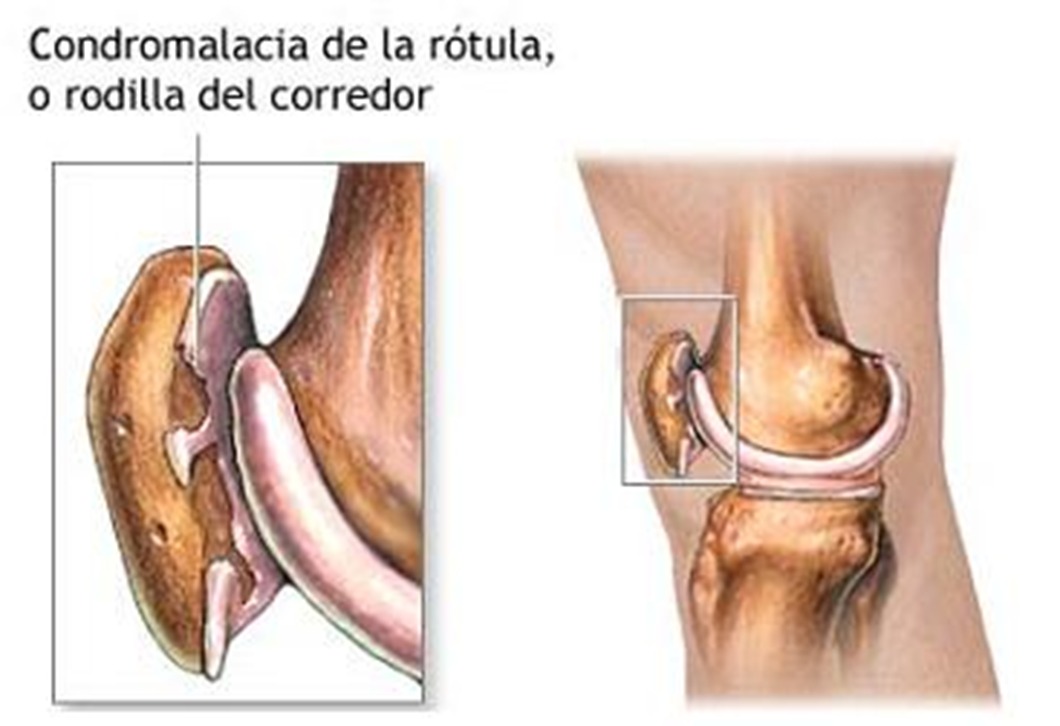 <p><span>Condición en la que se desgasta el cartílago de la rótula (rótula)</span></p>