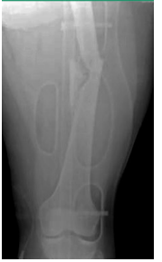 <p><strong>Femur Shaft Fracture: Background</strong></p><p>-Mechanism of Injury </p><ul><li><p>High _______ force → ___, being struck by car, fall from height, gunshot wound </p></li><li><p>Low energy force → ____ from stumbling or low height, ________</p></li></ul><p>-S/S</p><ul><li><p>____, swelling, deformity </p></li><li><p>____________ of thigh</p></li><li><p>Soft tissue injury and _________</p></li></ul><p>-Diagnosis</p><ul><li><p>X-ray → get other views to rule out other fractures</p></li></ul><p></p>
