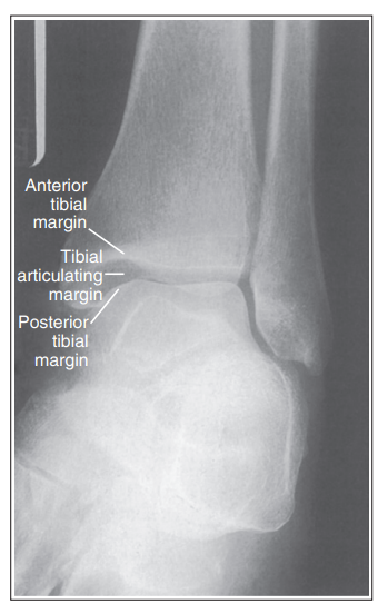 <p>What are the issues with this mortise ankle? </p>