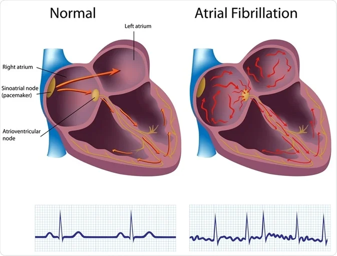 <ul><li><p>random signals from the AV node cause ventricles to contract <strong>quickly </strong>and <strong>irregularly</strong></p></li><li><p>can form clots, which can break off, reach the brain, and cause <strong><em>strokes</em></strong></p></li></ul><p></p>