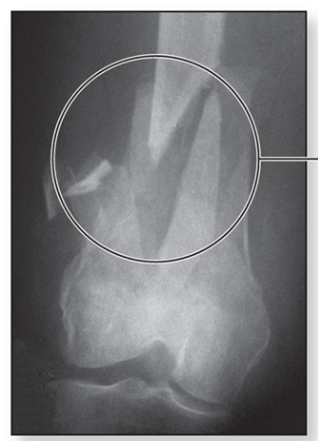 <p>What is a comminuted bone fracture?</p>