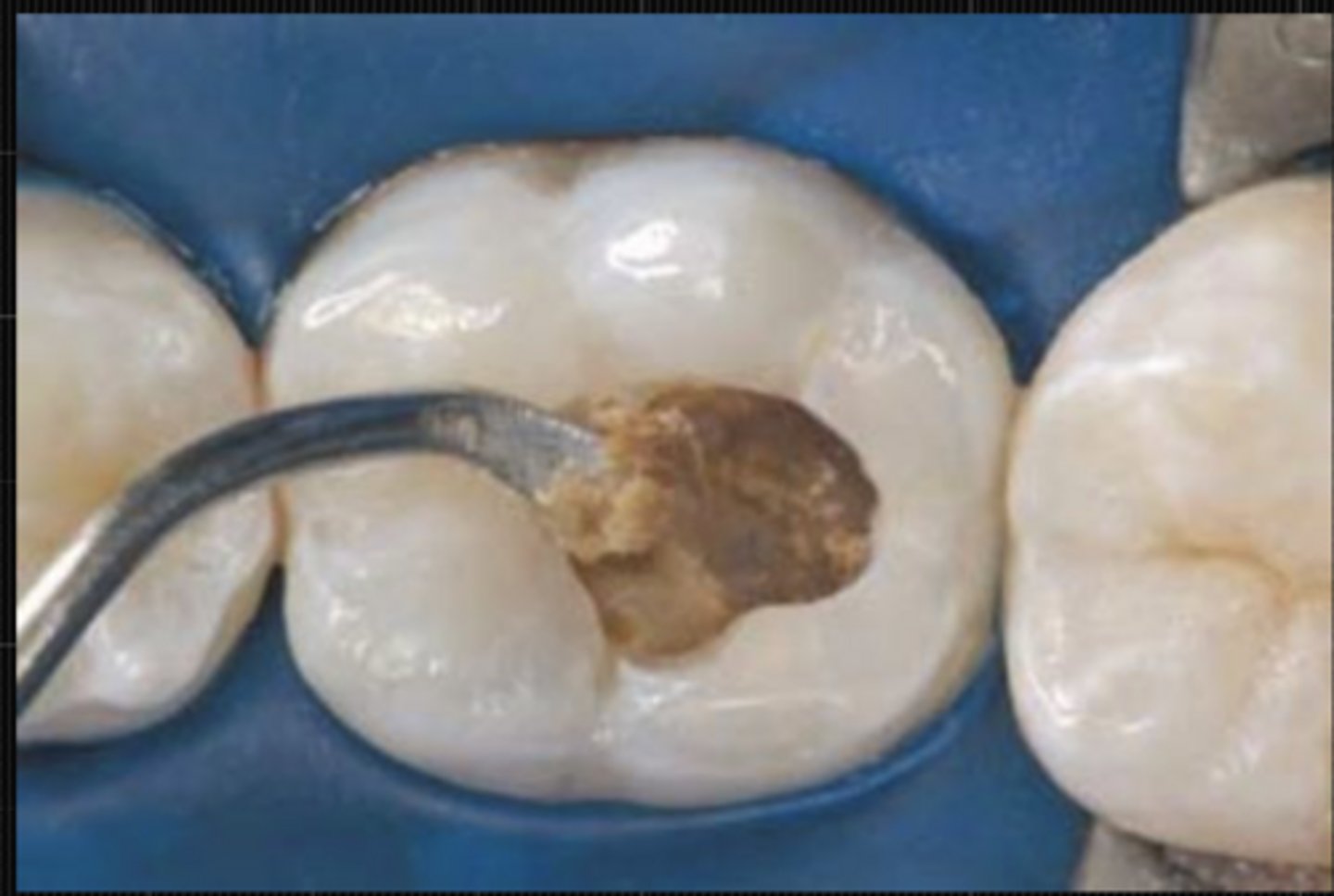 <p>Will deform when a hard instrument is pressed onto it and can be easily scooped up (with a sharp hand excavator) with little force being required</p>