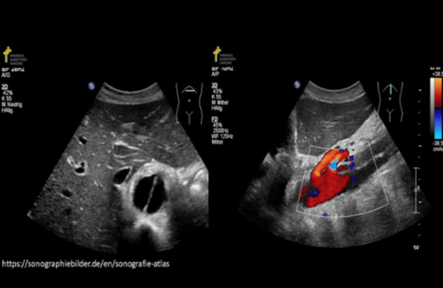 <p>Marfan syndrome</p>