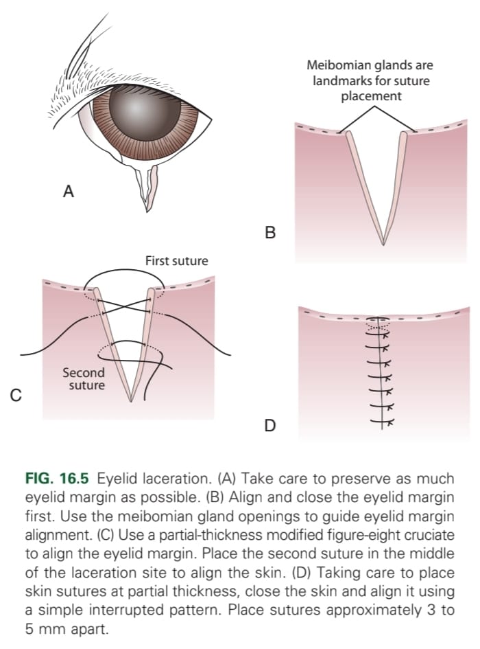 <p>Use partial thickness modified figure-8 cruciate at the margin then in the middle of the laceration to align the skin. Fill in with simple interrupted sutures 3-5 mm apart.</p>