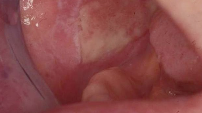 <p>How do patients with erosive lichen planus often describe eating?</p>