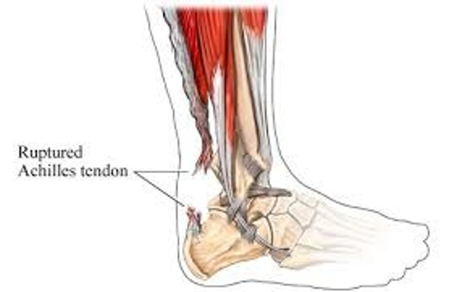 <p>- complete tearing of the triceps surae tendon</p><p>- presents with sudden snap with acute pain, inability to stand on the affected side</p>