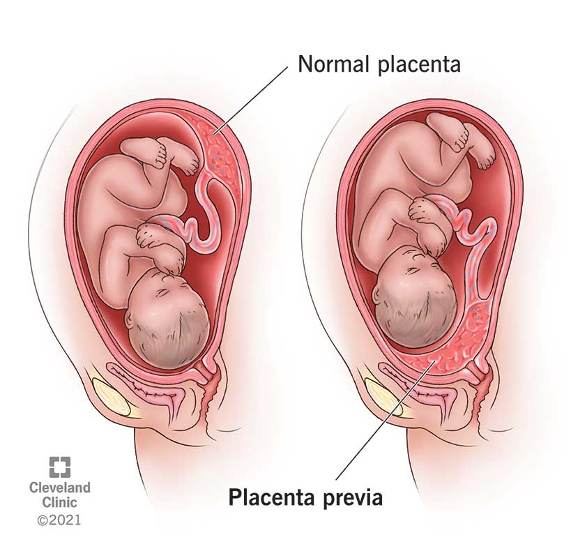 <p>What is placenta previa and what is the key sign to look for when assessing?</p>