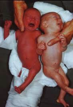 <p><strong>Polycythemia</strong></p><p>-Hyperviscosity with ___________ perfusion of capillary beds</p><p>-Epidemiology&nbsp;</p><ul><li><p>Most prevalent in SGA and ___ populations&nbsp;</p></li><li><p>_________ cord clamping is the most common cause of benign polycythemia&nbsp;</p></li><li><p>Other causes → twin-twin transfusion, maternal-fetal transfusion, and chronic intrauterine hypoxia&nbsp;</p></li></ul><p>-Symptoms&nbsp;</p><ul><li><p>________, respiratory distress, hypoglycemia, poor feeding, _______, irritability, and lethargy&nbsp;</p></li></ul><p>-Diagnosis&nbsp;</p><ul><li><p>Screen with capillary ___________ (heelstick) → if &gt; 68% hct then do peripheral venous hct&nbsp;</p></li><li><p>If &gt; __% hct = hyperviscosity&nbsp;</p></li></ul><p>-Treatment&nbsp;</p><ul><li><p>Isovolemic partial exchange ___________ with normal saline&nbsp;</p></li><li><p>Blood ________ through umbilical venous line&nbsp;</p></li><li><p>Desired hct of <strong>___-___%&nbsp;</strong></p></li></ul><p></p>