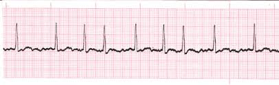 <p>PP:<br>rate: slow<br>fast→bad</p><p>rhythm: irregular</p><p>pacer site: multiple ectopic sites<br>rape reentry atrial circuits</p><p>morphology: f waves (350-600 bpm in II/III/AVF/V1)<br>chaotic atrial spikes<br>no P wave<br>no single atrial impulse→depolarizes both atria</p><p>interval: RR varies<br>QRS normal</p><p>ventricular response: irregular (slow or fast)<br>controlled→60-80 bpm<br>uncontrolled→160-180 bpm</p>