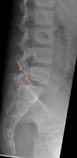 <p>spondylolysis (lumbar)</p>
