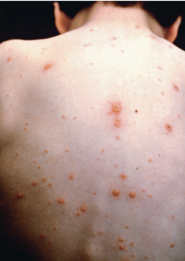 <ul><li><p>dsDNA with an envelope</p></li><li><p> Causative agent of <strong>chickenpox</strong> </p></li><li><p> Characteristic vesicular rash and fever</p><ul><li><p><strong> Spread via aerosols</strong></p></li></ul></li><li><p> After infection, virus can remain dormant in nerves</p></li><li><p> <strong>Reactivation results in shingles (herpes zoster)</strong></p></li><li><p> Spreads along the involved sensory nerve (Age- This is known as immunosenescence, and it increases the risk of shingles) and rash appears on one side of the body with severe pain</p></li><li><p><strong>Increased risk of Post-Herpetic Neuralgia (PHN)</strong></p></li><li><p><strong>PNH Explained: </strong>PHN is chronic nerve pain that persists after the shingles rash resolves. It is caused by nerve damage from the VZV reactivation.</p></li><li><p><strong>Age and Nerve Damage: </strong>Older adults are more likely to develop PHN because their nerves are more vulnerable to damage, and their bodies have a reduced capacity for repair.</p></li></ul><p></p>