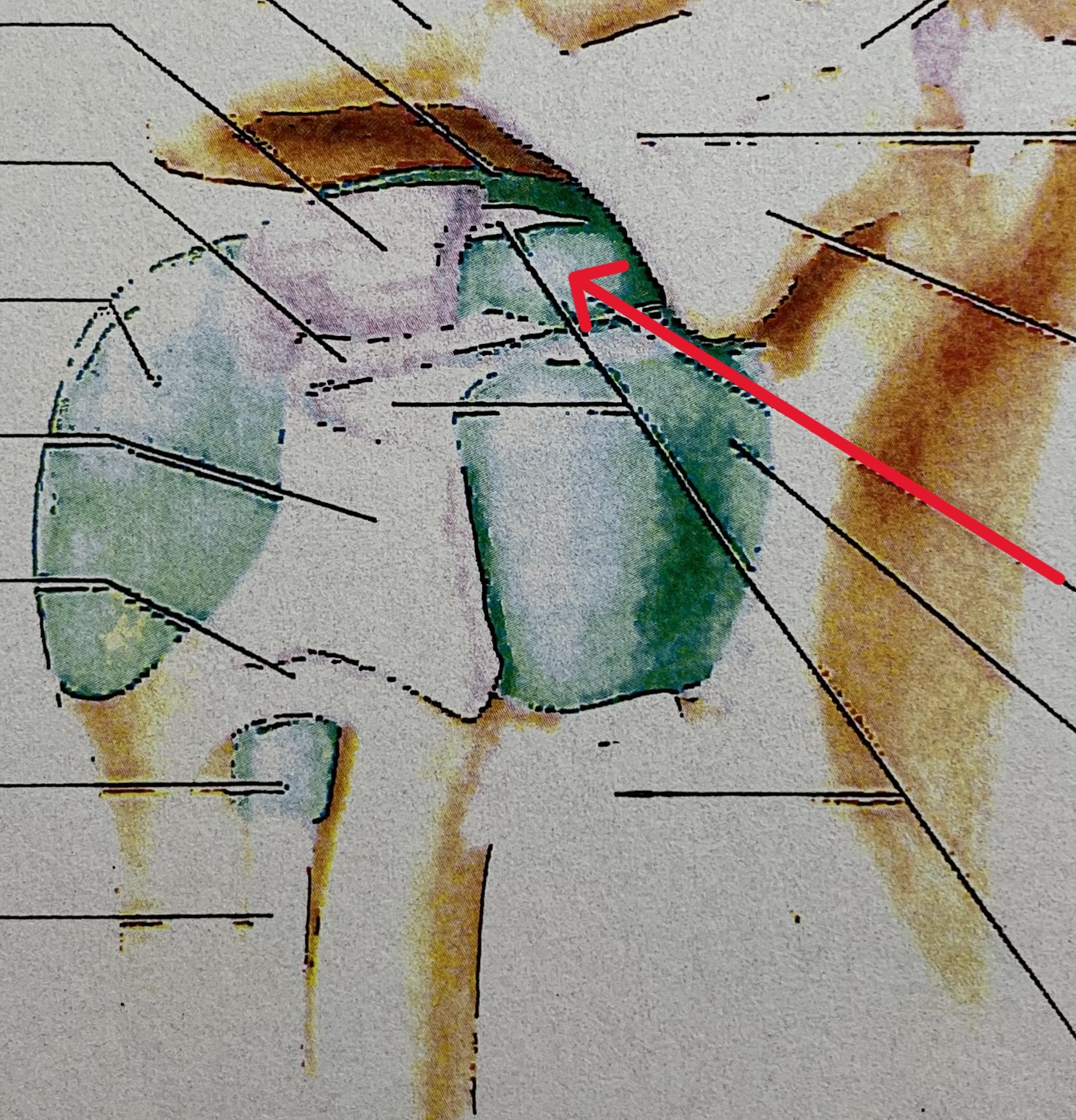 <p>Which bursa of the shoulder is&nbsp;located anterior to the subscapularis muscle and deep to the coracoid process?</p>