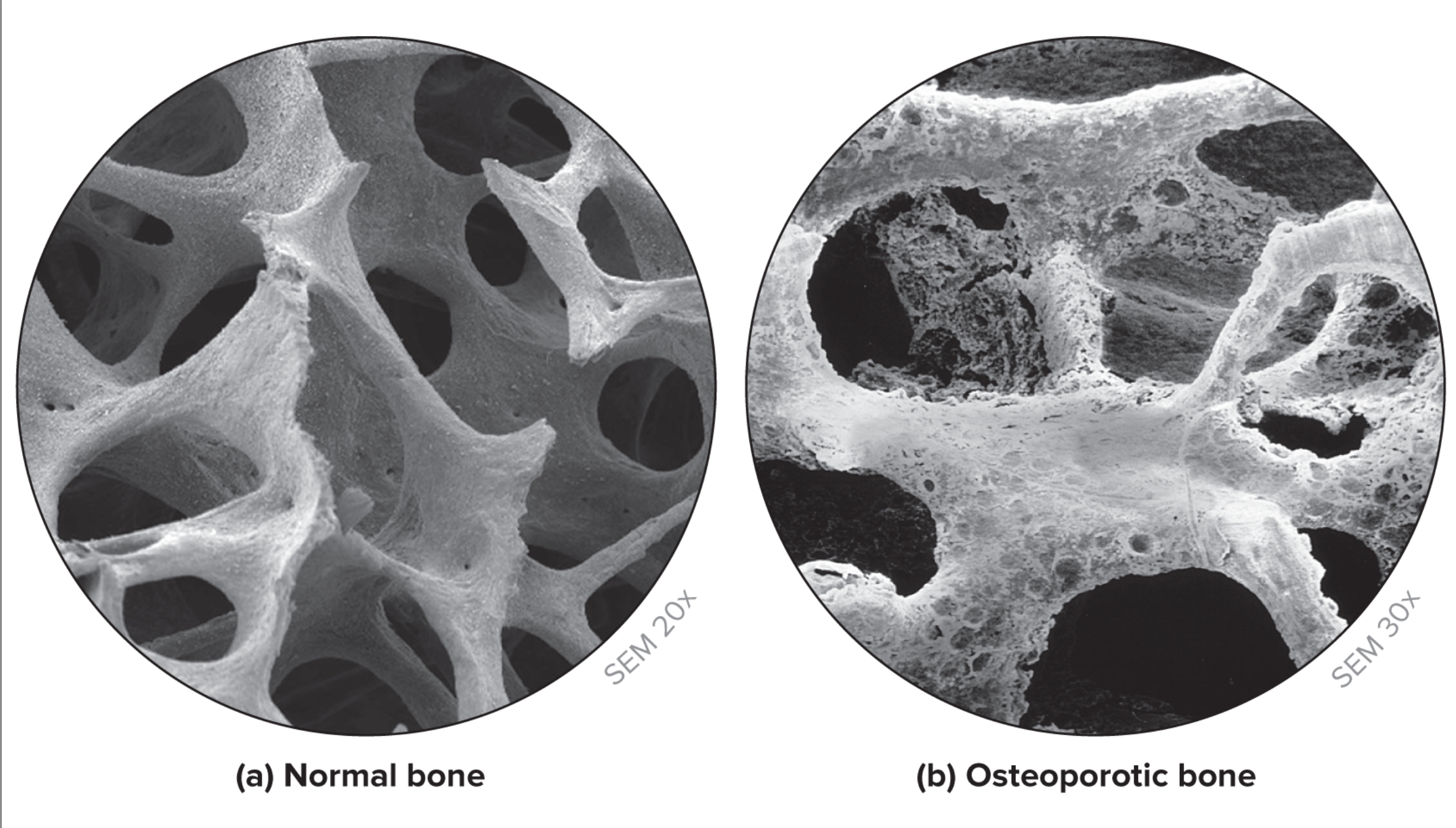 <p>What is osteoporosis?</p>
