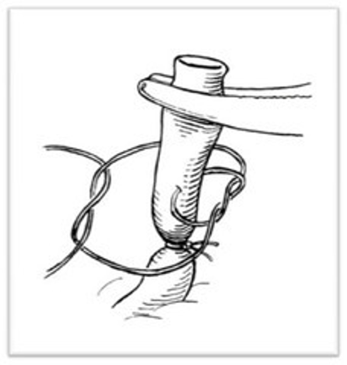 <p>Lister used ligatures that had been soaked in carbolic acid as ligatures to stem bleeding during surgery</p>