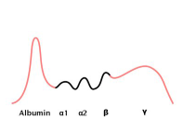 increased albumin, bridge from gamma to beta; cirrhosis