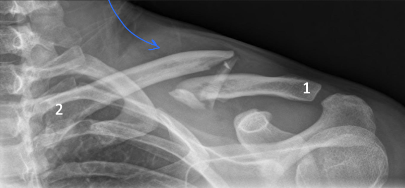 <ul><li><p>the middle and lateral 1/3 area where the bone “changes direction”; subclavian groove</p></li></ul><p></p>