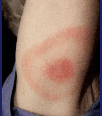 <p>What specific clinical sign is seen in Lyme disease in humans?</p>